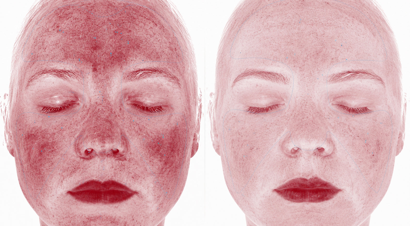 Comparative visual mapping of the appearance of visible red areas